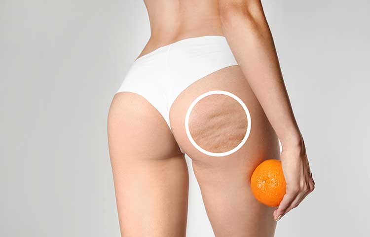 Traitement de la cellulite et peau d'orange à Nantes 