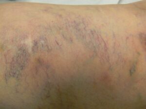 Traiter les varicosités à Nantes