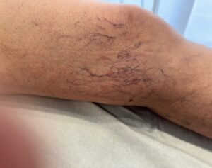 Traiter les varicosités à Nantes